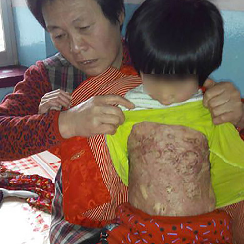 4岁女童王妤心不慎被炉上的开水严重烫伤，受伤面积达40%
